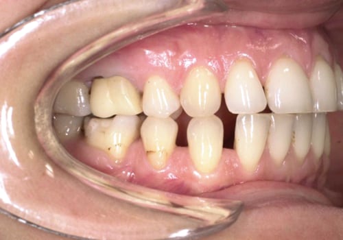 Danni da trattamenti dentali: quando il dentista può essere ritenuto responsabile